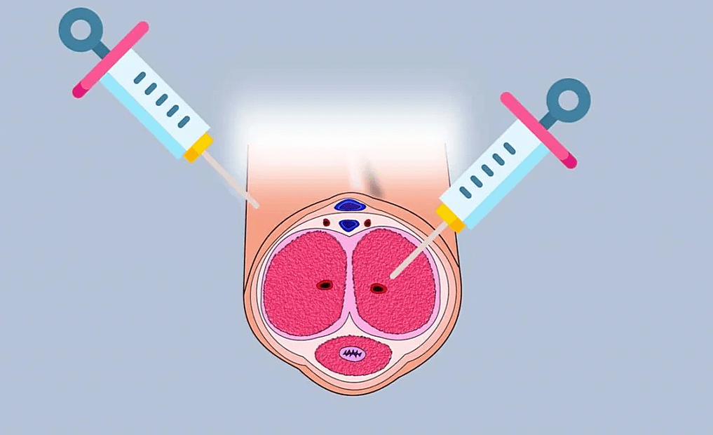 Sites for hyaluronic acid injection