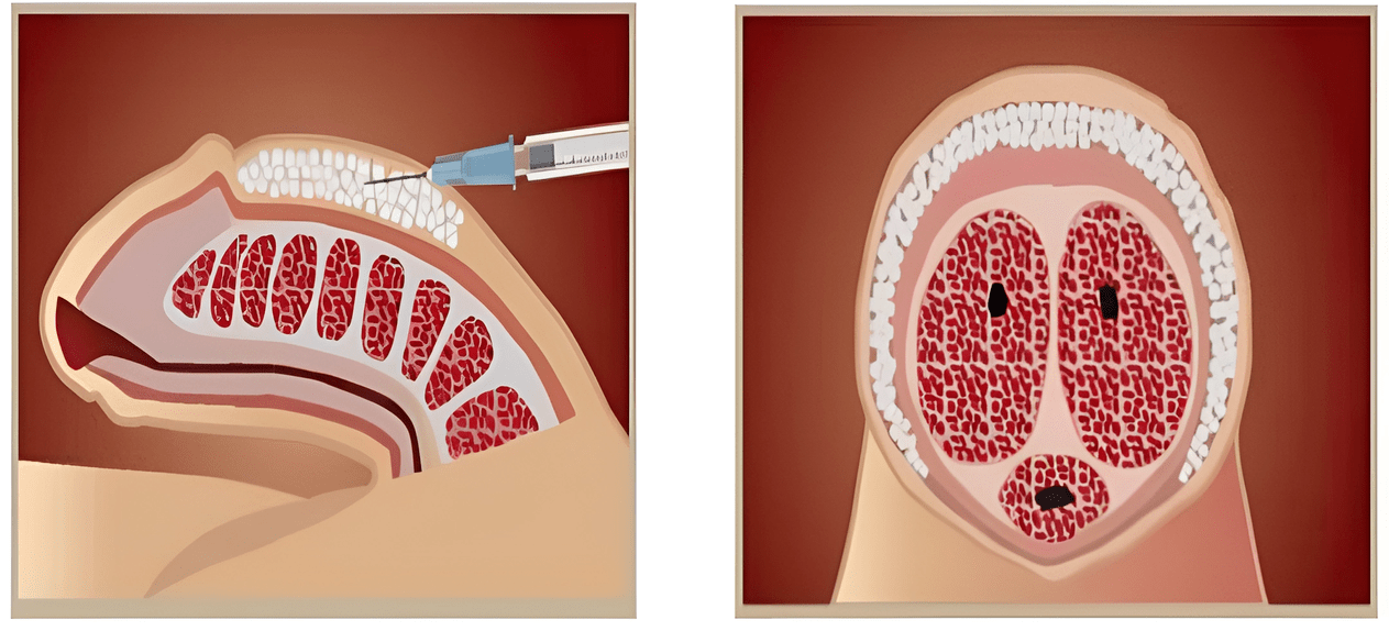 filler injection area