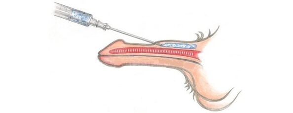 lipofilling, which allows you to increase the size of the penis